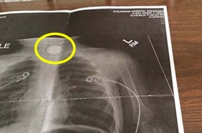 Button cell removed from 10-year-old