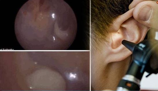 doctors found a teeth in little boys ear after he got pain