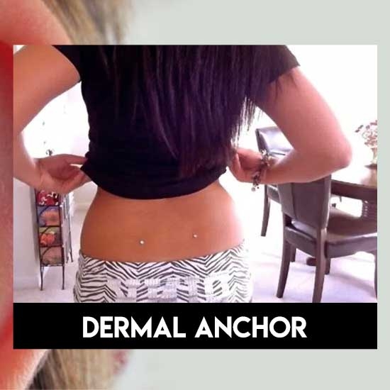 Dermal anchor