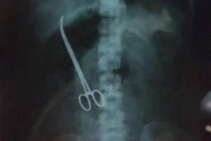 Shocking - Doctors leave behind forceps in woman's abdomen; Found after 3 months