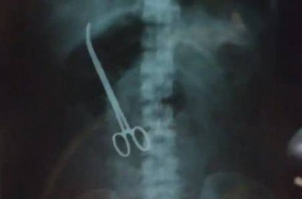 Hyderabad - Doctors leave behind forceps in womans abdomen
