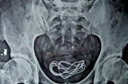 man complains of stomach pain had mobile phone charger in bladder