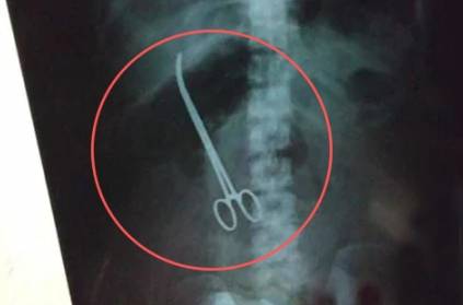 surgeons found Scissors in a woman stomach, left before 3 months