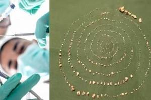 Chennai doctors find 500+ TEETH from 7-Year-old boy’s mouth; Possible REASONS are shocking!