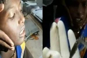 Video: Jilebi Fish Enters into Little Boy's Nose; Doctor Struggles to Take it Out