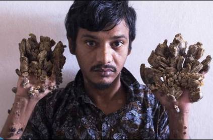 Bangladesh \'Tree Man\' Wants Hands Amputated To Relieve Pain