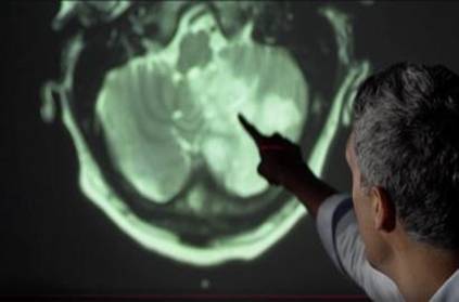 brain damage in covid19 patients found scientist warn stroke