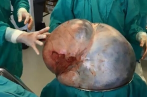Doctors remove huge tumor weighing 34 kg from woman's ovaries