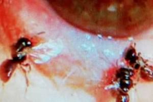 Shocking! Bees found living inside woman's eye