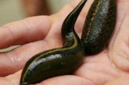 Man Coughing Non Stop Had 2 Live Leeches Stuck To Throat 