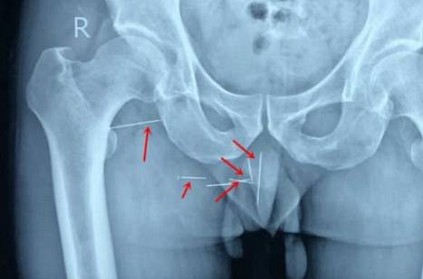 Man lives with 8 needles stuck in his backside for a decade