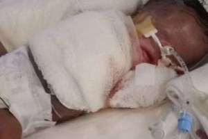 SHOCKING! Baby born without skin, doctors fighting to keep him alive.