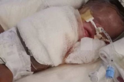 Texas baby born with nearly no skin. Doctors are fighting to keep him