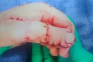 Girl Fractures Thumb; Doctors' Careless Surgery Makes Her Lose Her 'Big Toe'