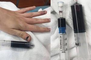 Woman's blood turns blue after she takes toothache medicine!