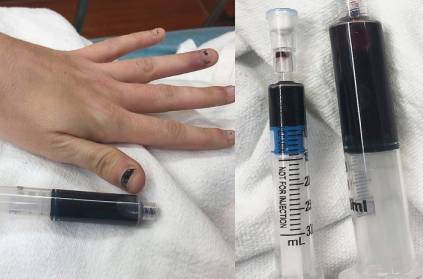 Woman\'s blood turns blue after she takes toothache medicine
