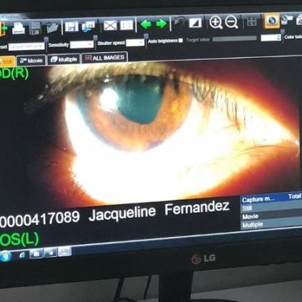 Jacqueline Fernandez suffers a permanent eye injury