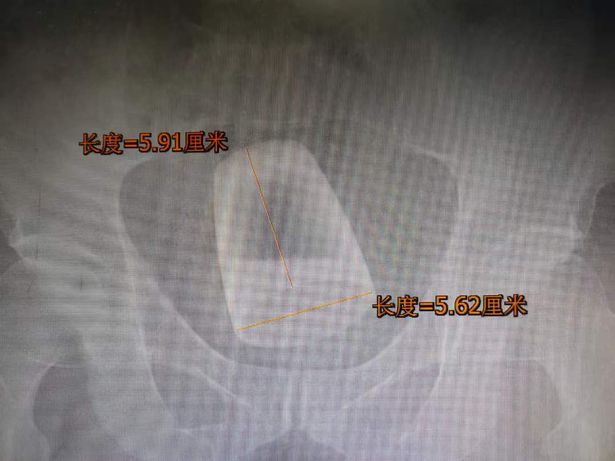 china man undergoes surgery to remove beer glass from rectum