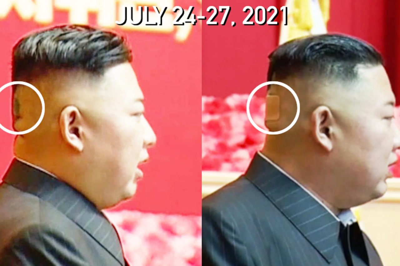 Kim Jong Un’s Head Bandage to List of Health Mysteries