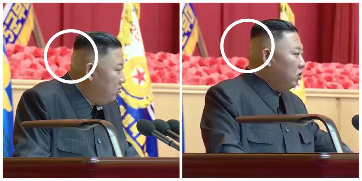 Kim Jong Un’s Head Bandage to List of Health Mysteries
