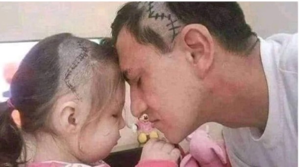dad shaves head to look a like his daughter head after her surgery