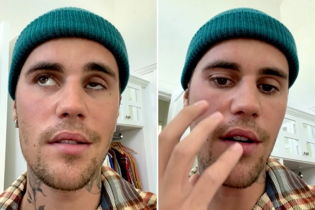 Justin Bieber says his face partly paralyzed fans sad