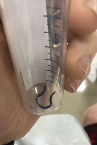 man found his nose ring which missed before 5 years in his lungs