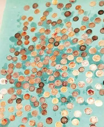 Karnataka Doctors remove 187 coins from old man stomach 