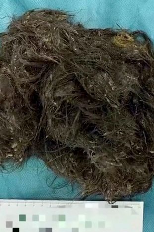 china surgeon remove 3 kilo hair ball from woman stomach